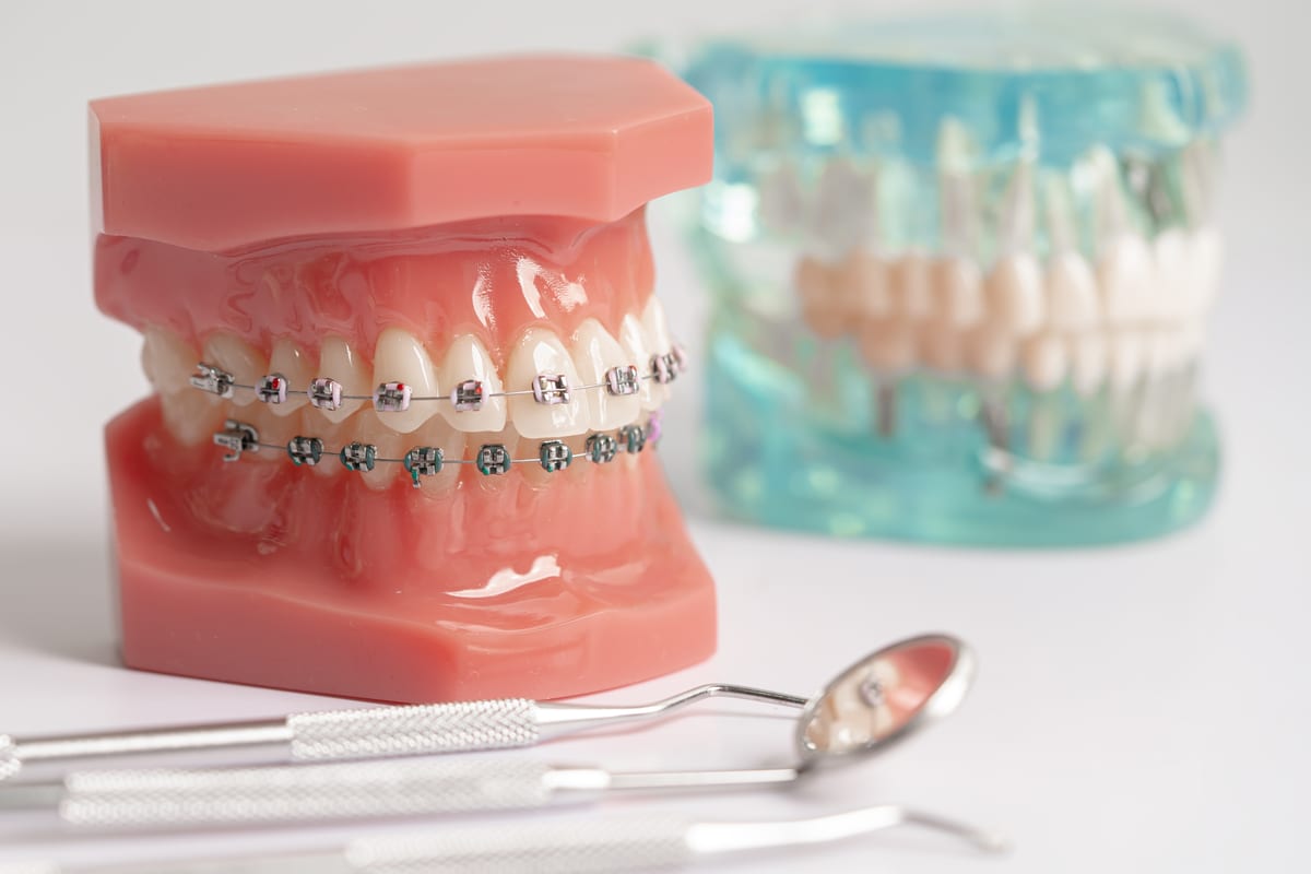 Braces 1 at Khan Dental Studio