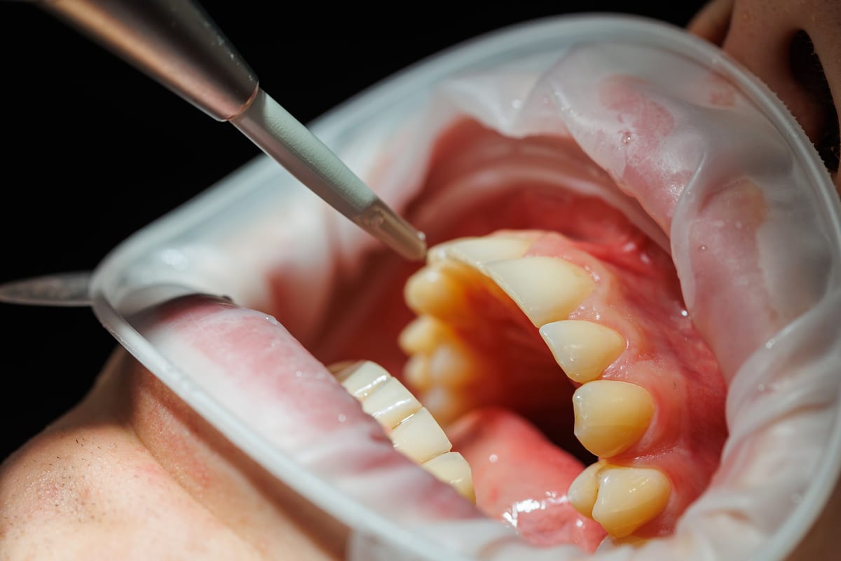 Gum disease treatment 1 at Khan Dental Studio