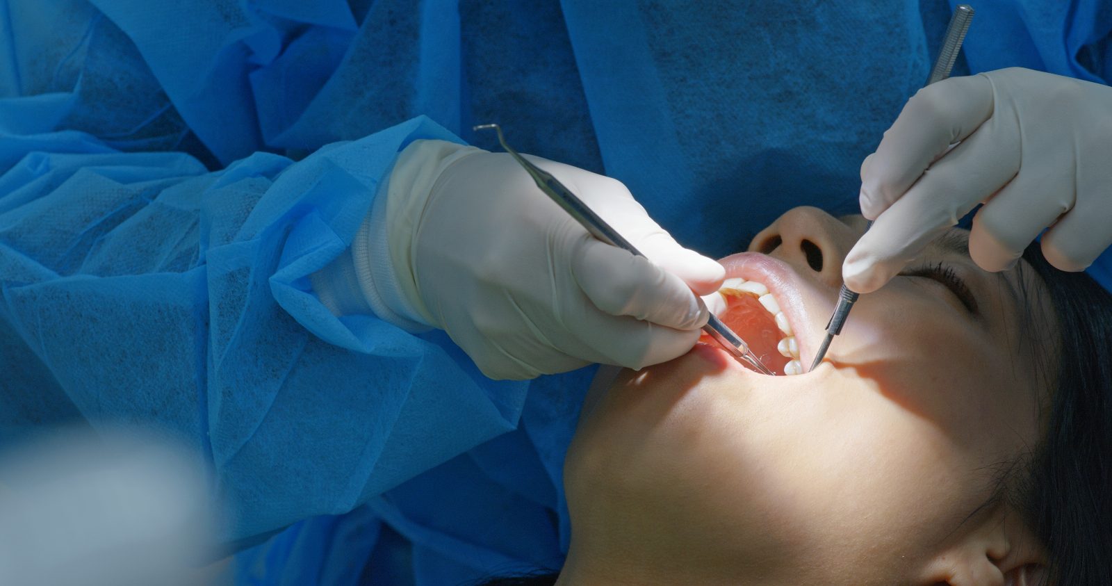 Tooth extraction 23 at Khan Dental Studio