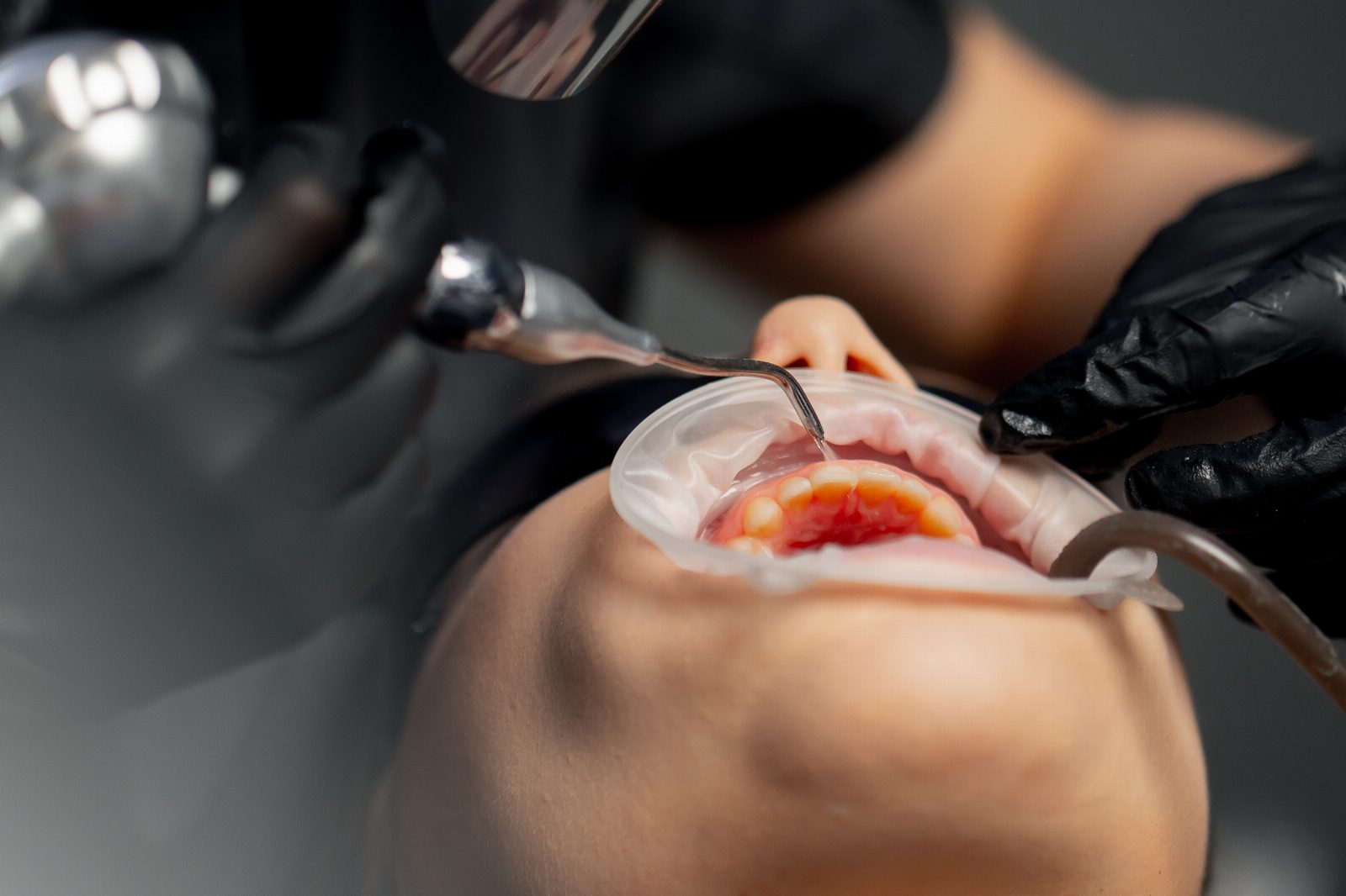 Tooth extraction 25 at Khan Dental Studio