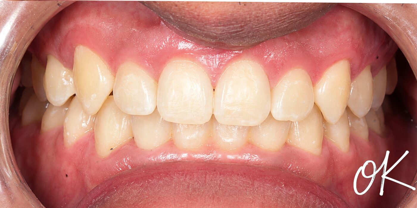 Crowding guided back into line — after treatment
