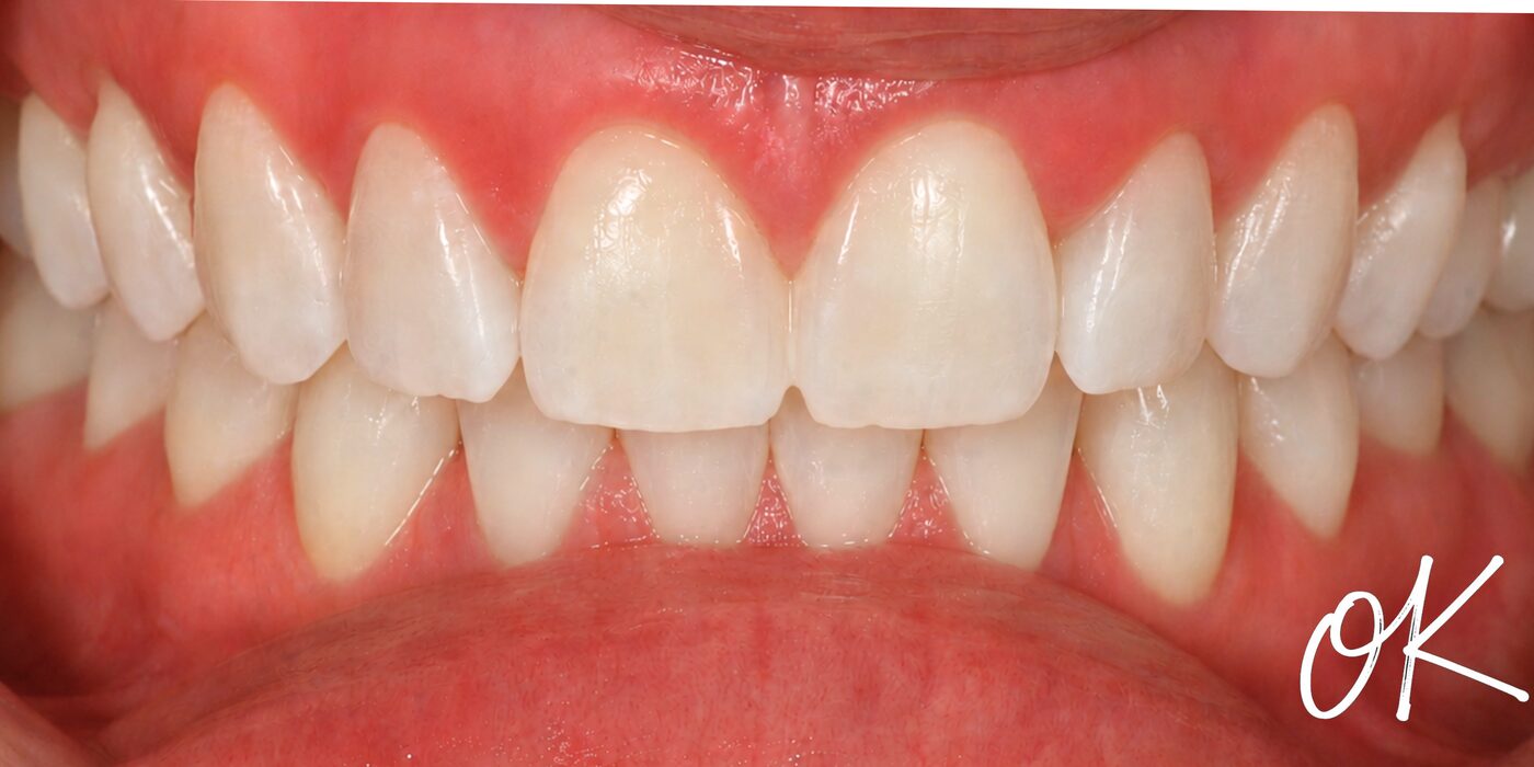 Straightened first, then whitened — after treatment