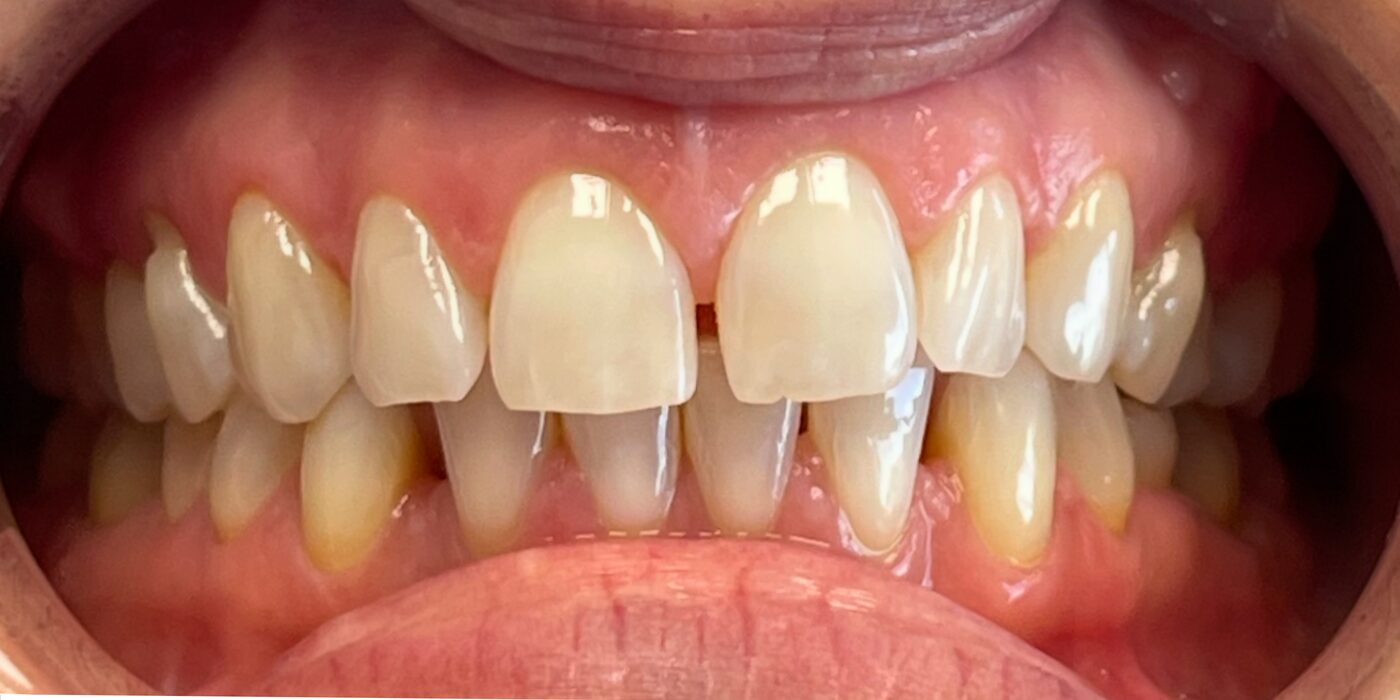 Straightened first, then whitened — before treatment