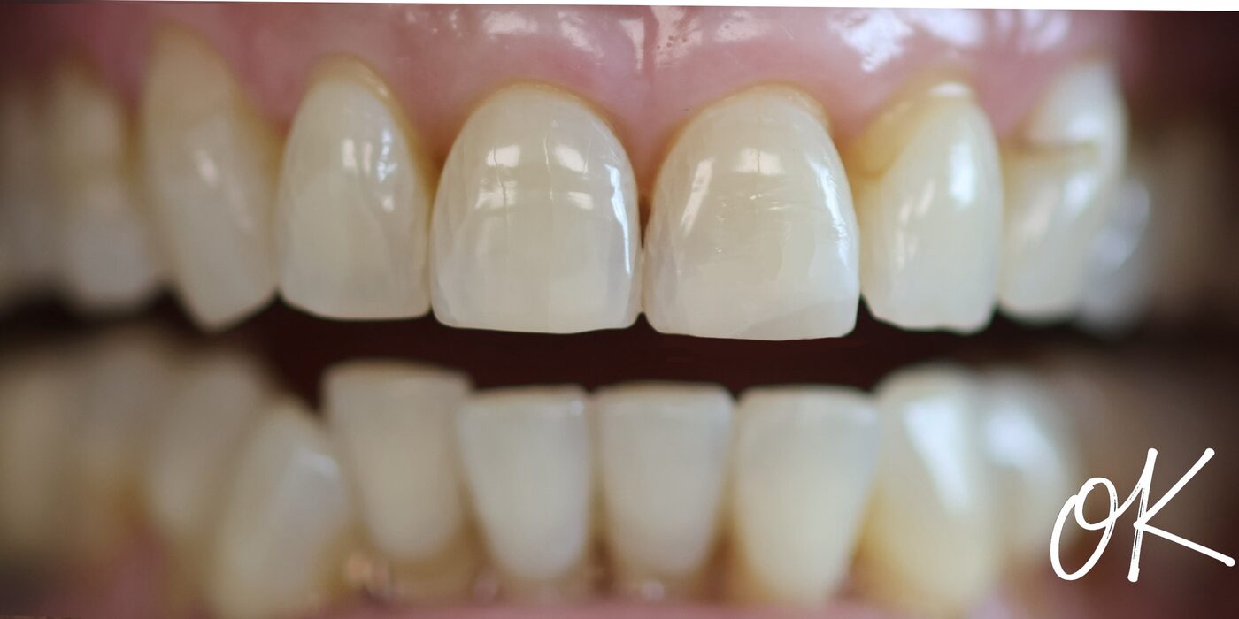 Chipped front edges rebuilt — after treatment