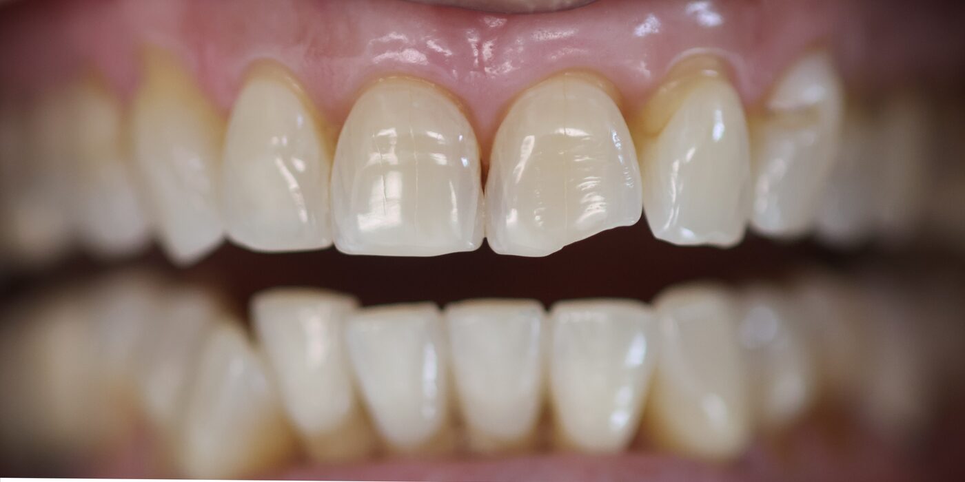 Chipped front edges rebuilt — before treatment