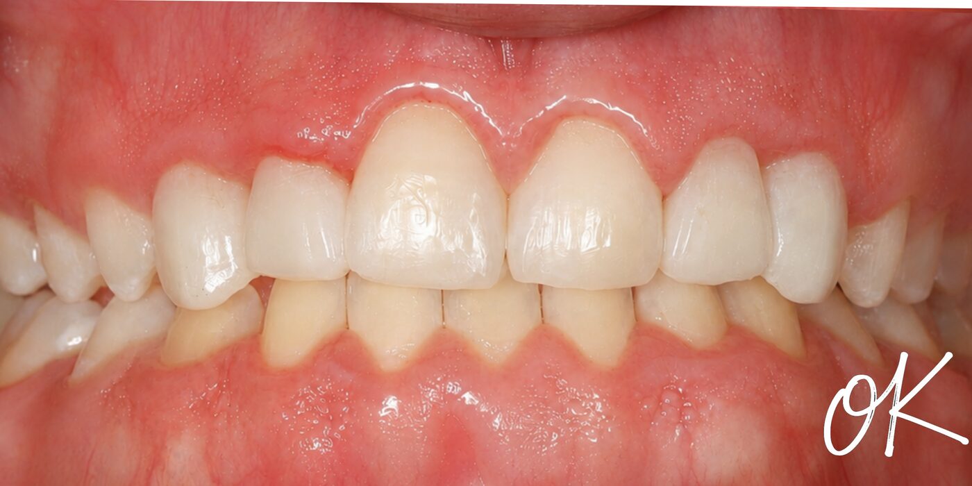 Closing spaces between the front teeth — after treatment