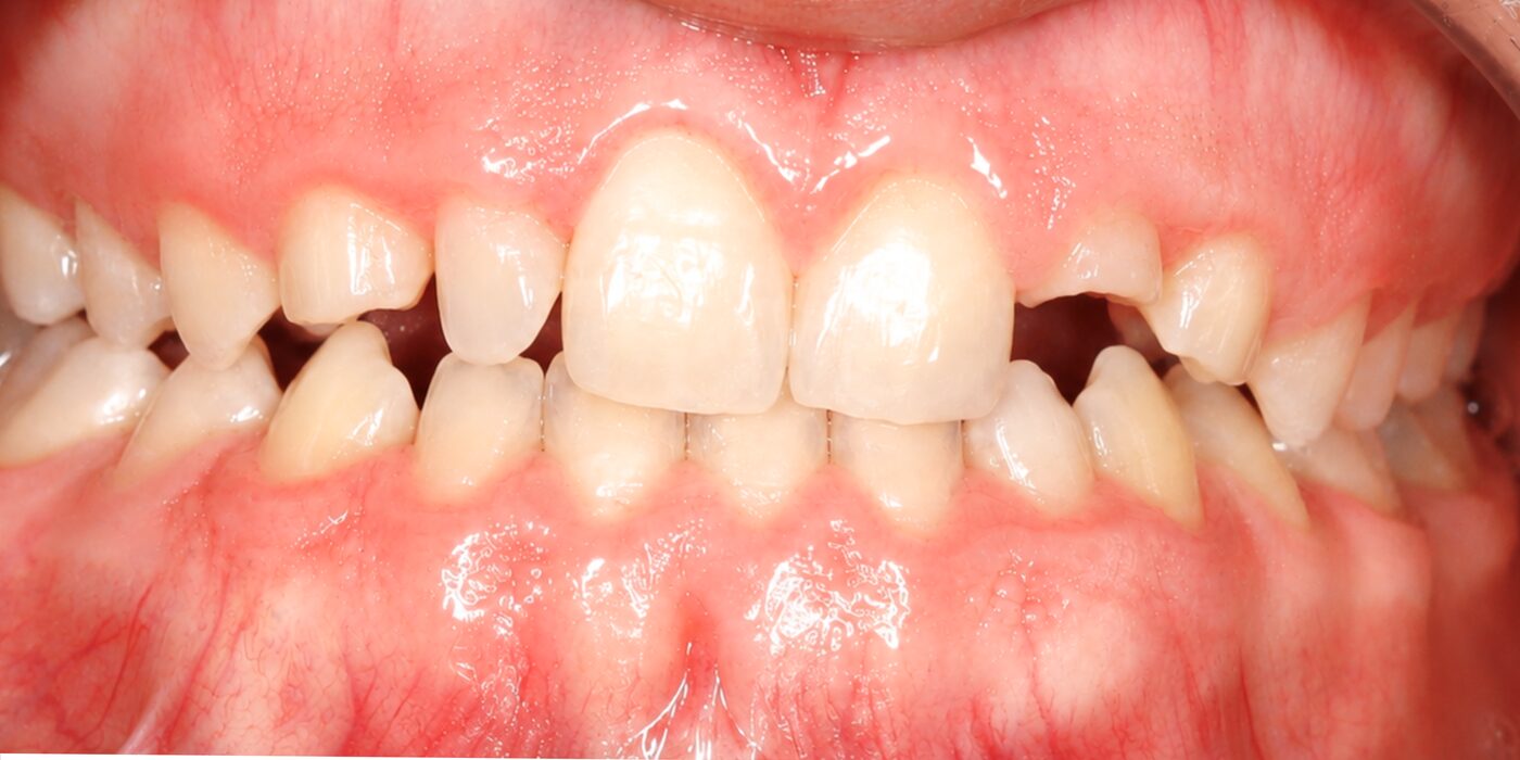 Closing spaces between the front teeth — before treatment