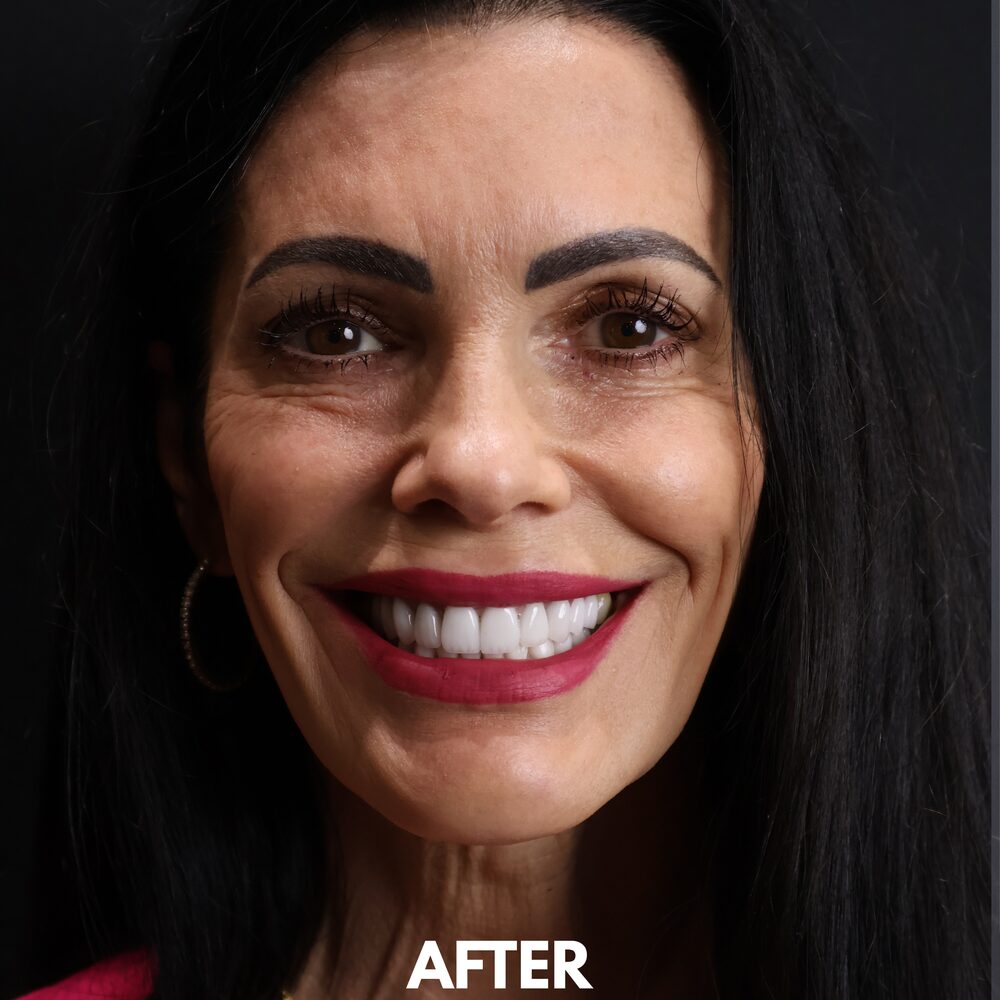 Veneer case completed at Khan Dental Studio
