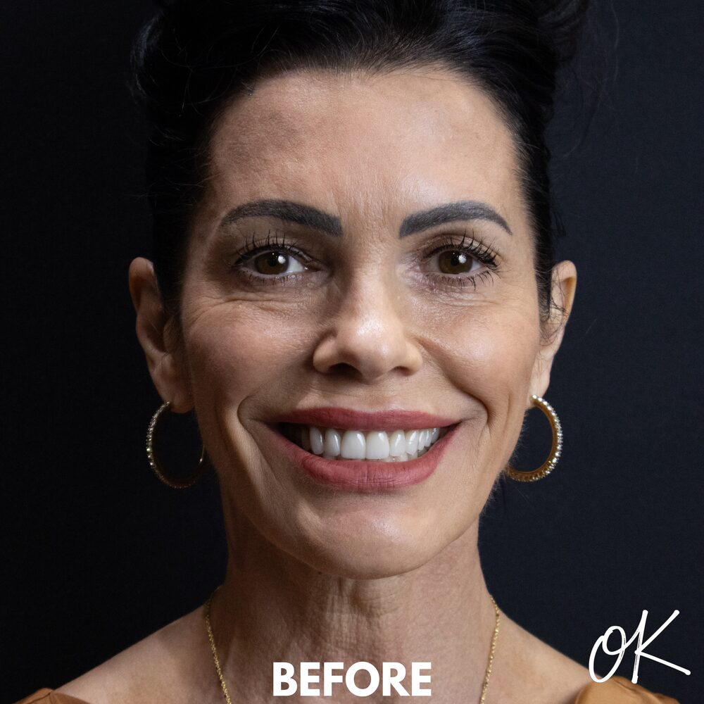 Full face before porcelain veneers