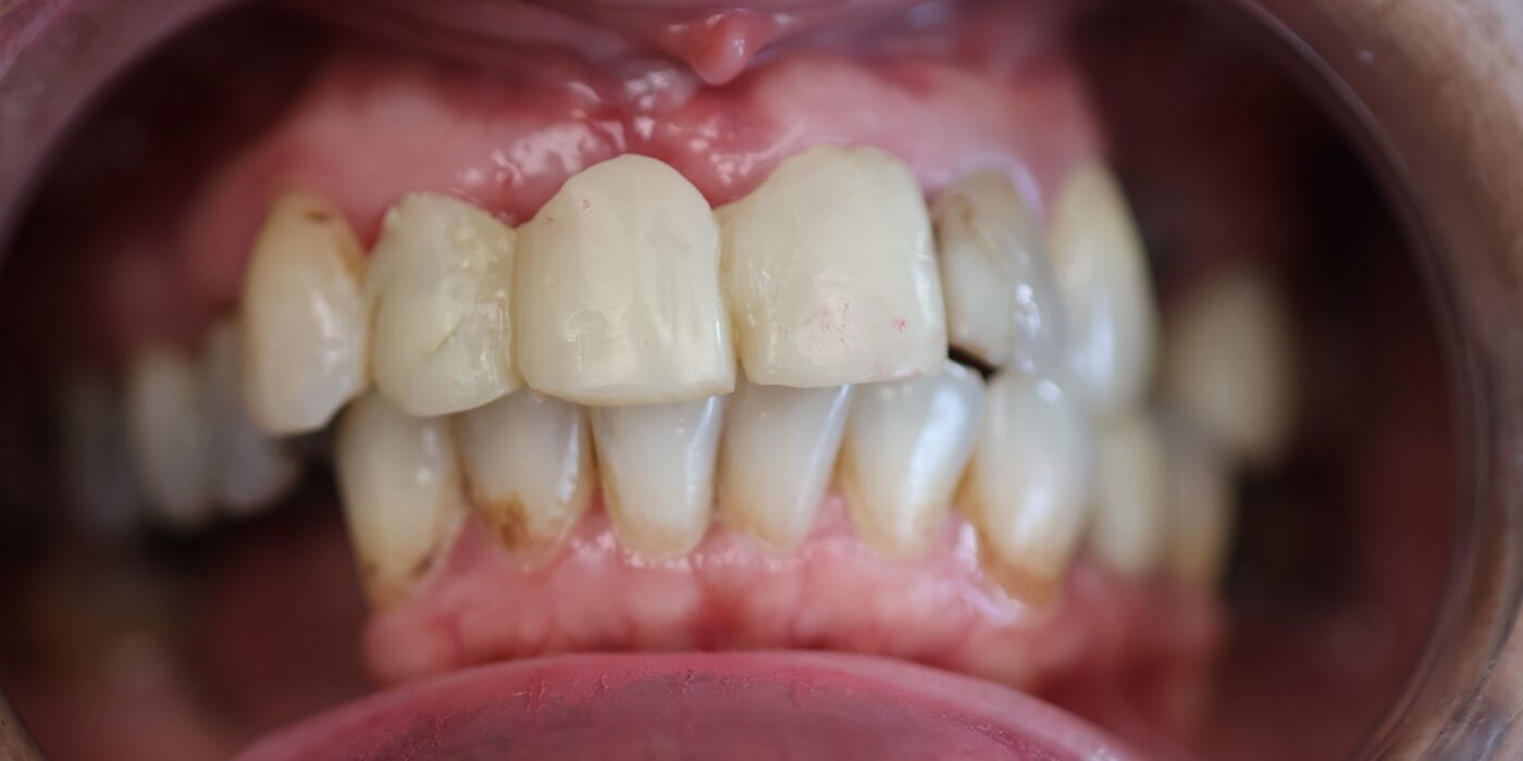 Rebuilding a worn bite — before treatment